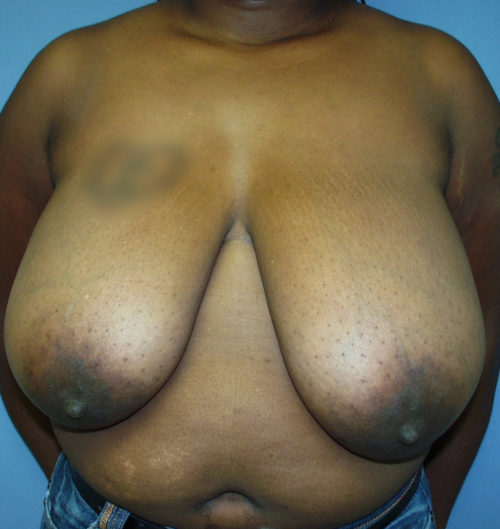 Breast Reduction Case 1540 Before Photo Breast Reduction