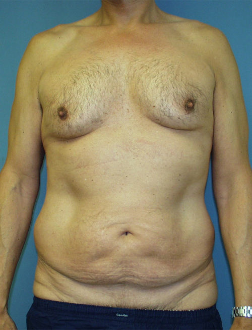 Male Abdominoplasty/Body Lift