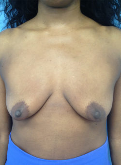 Breast Lift/Augmentation