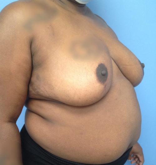Breast Reduction Case 1540 After Photo Breast Reduction