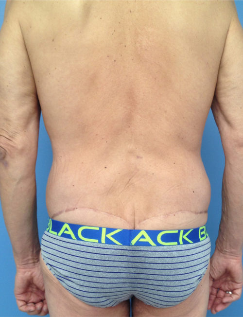 Male Abdominoplasty/Body Lift Case 1558 After Photo Male Abdominoplasty/Body Lift