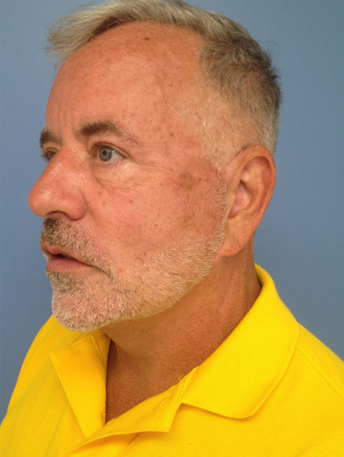 Male Facelift