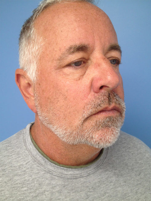 Male Facelift