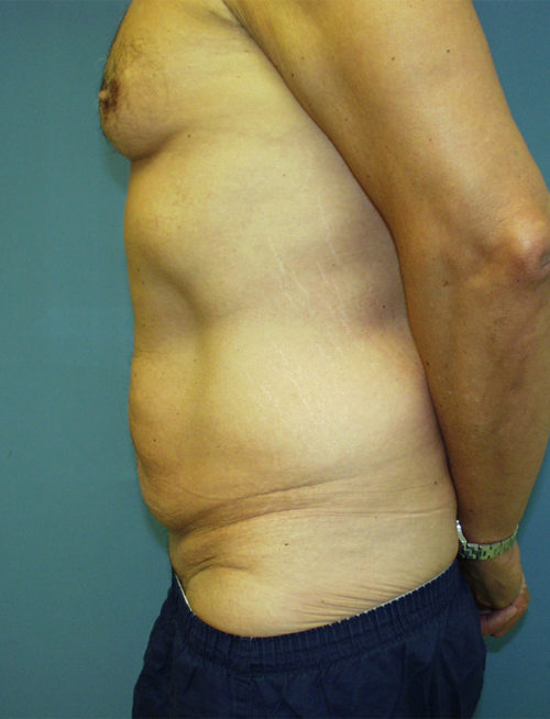 Male Abdominoplasty/Body Lift Case 1558 Before Photo Male Abdominoplasty/Body Lift