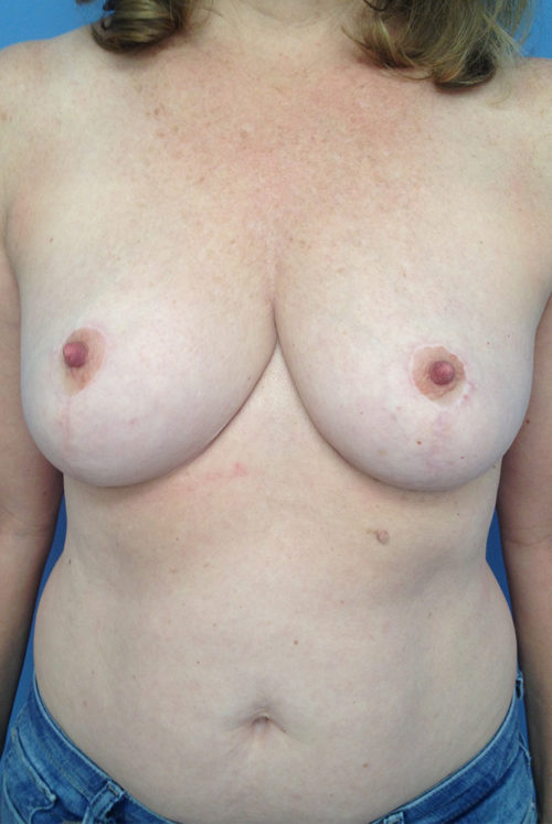 Breast Lift