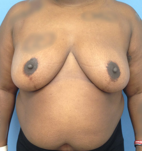 Breast Reduction Case 1540 After Photo Breast Reduction