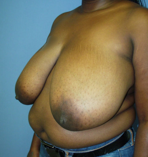 Breast Reduction Case 1540 Before Photo Breast Reduction