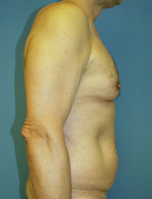 Male Abdominoplasty/Body Lift