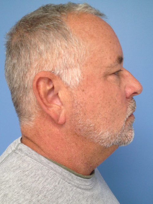 Male Facelift