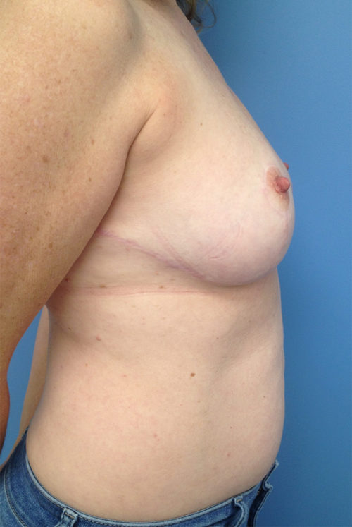 Breast Lift Case 1529 After Photo Breast Lift