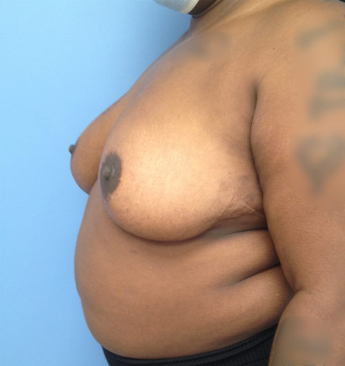 Breast Reduction Case 1540 After Photo Breast Reduction