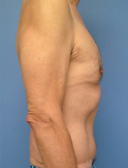 Male Abdominoplasty/Body Lift