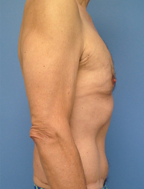 Male Abdominoplasty/Body Lift Case 1558 After Photo Male Abdominoplasty/Body Lift