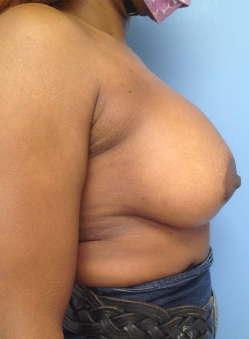 Breast Lift/Augmentation