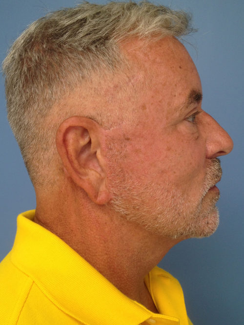 Male Facelift