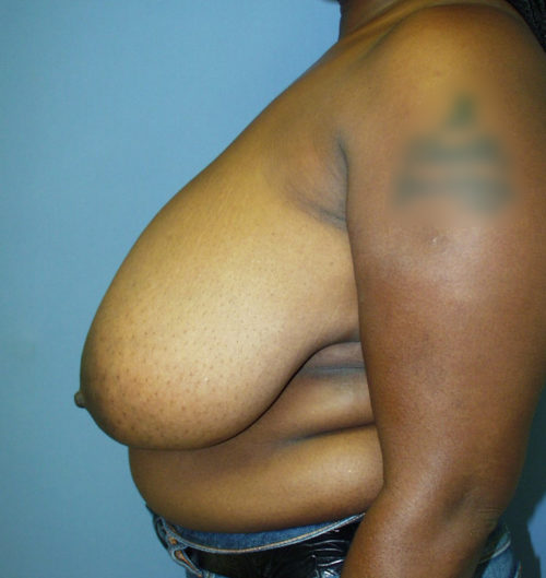 Breast Reduction Case 1540 Before Photo Breast Reduction