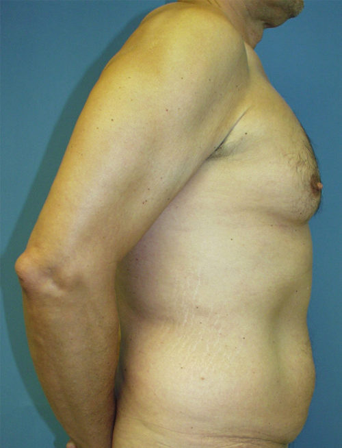 Male Abdominoplasty/Body Lift