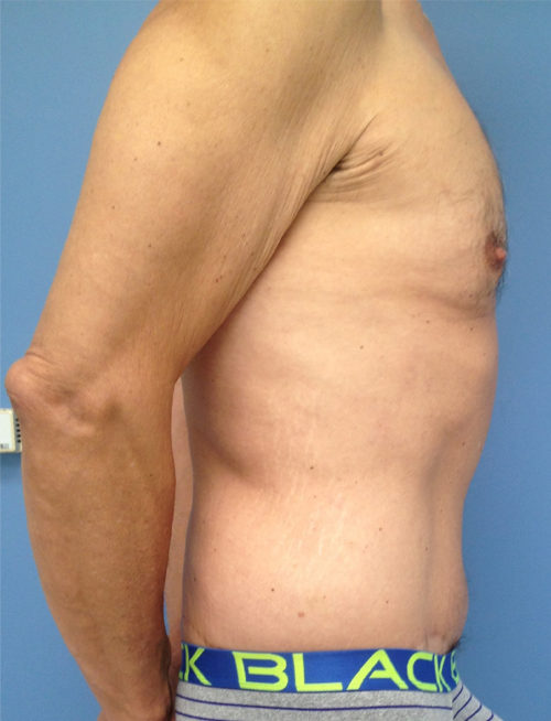 Male Abdominoplasty/Body Lift