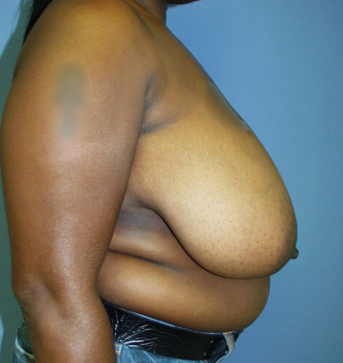 Breast Reduction Case 1540 Before Photo Breast Reduction