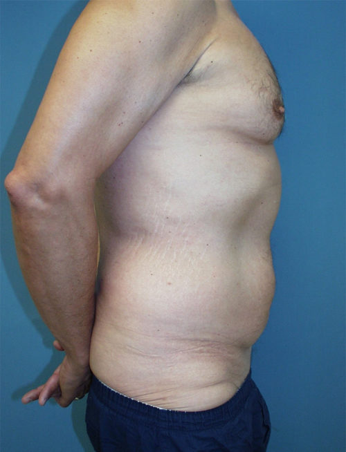 Male Abdominoplasty/Body Lift