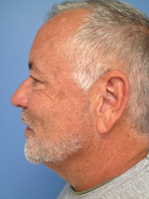 Male Facelift