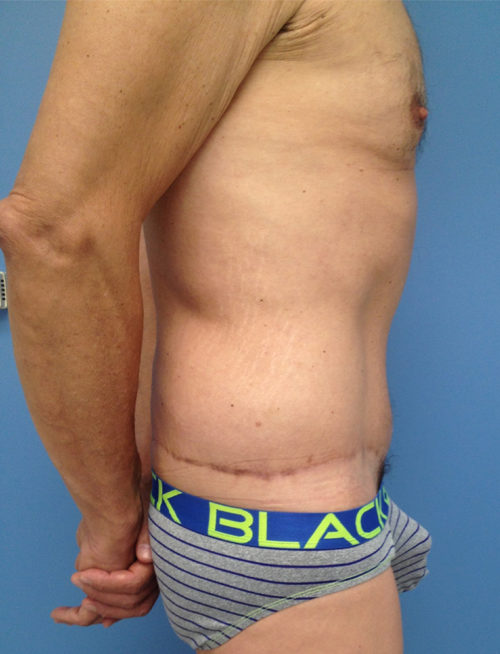 Male Abdominoplasty/Body Lift Case 1558 After Photo Male Abdominoplasty/Body Lift