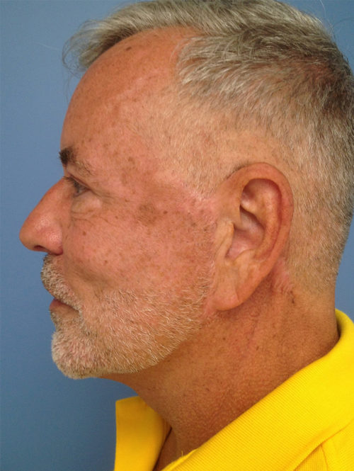 Male Facelift