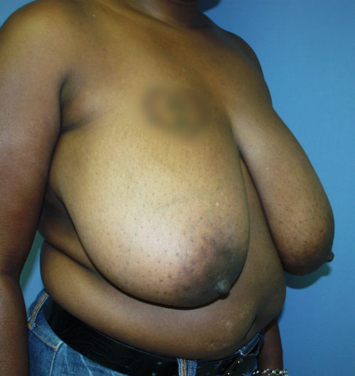 Breast Reduction Case 1540 Before Photo Breast Reduction