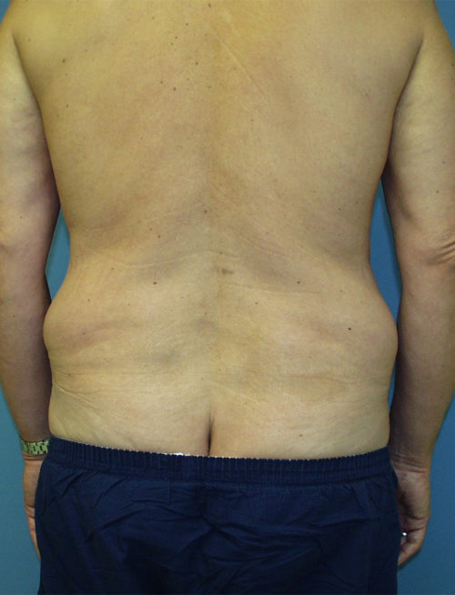 Male Abdominoplasty/Body Lift