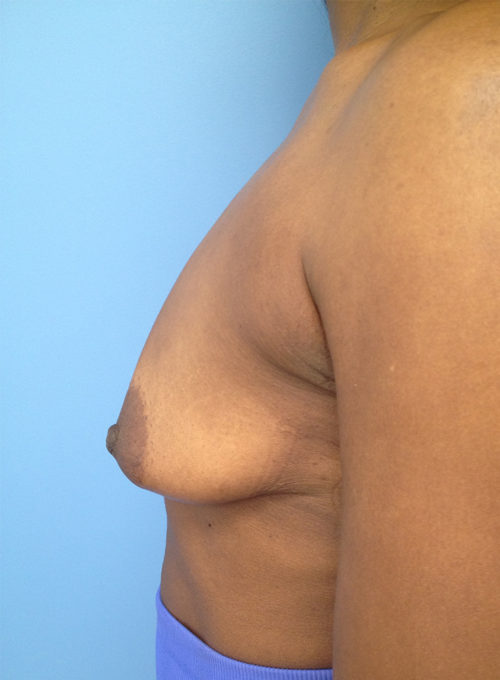 Breast Lift/Augmentation Case 1573 Before Photo Breast Lift/Augmentation