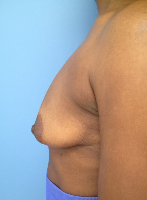 Breast Lift/Augmentation