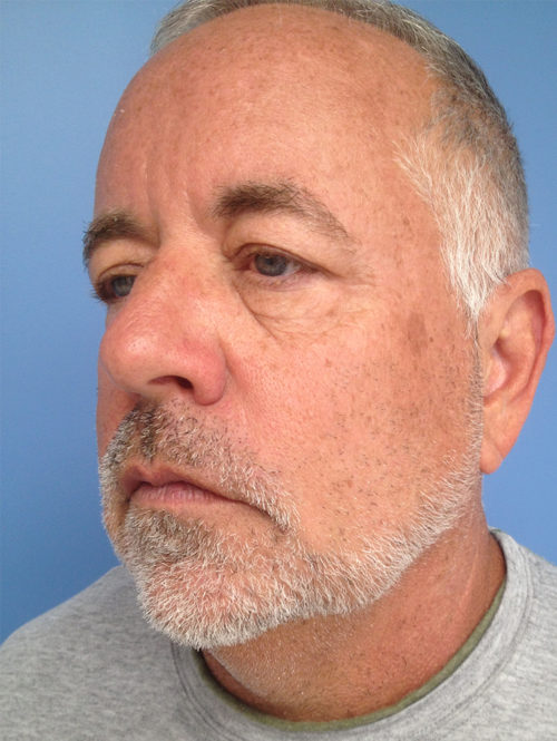 Male Facelift