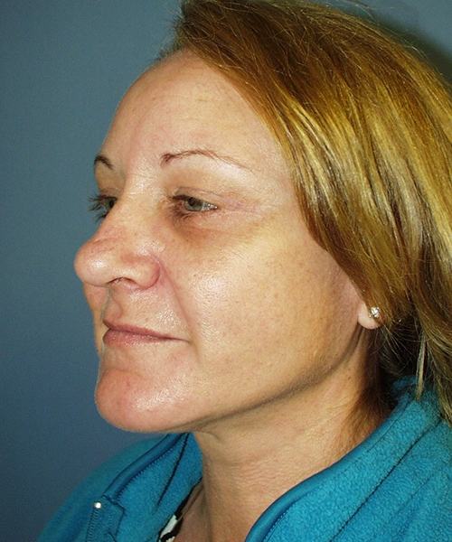 Face & Neck Lift