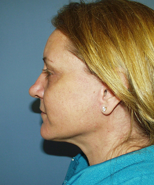 Face & Neck Lift