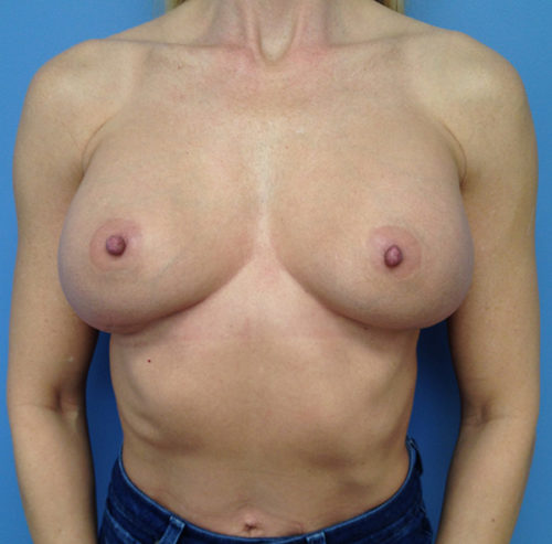 Breast Augmentation