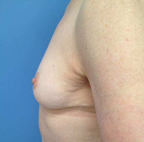 Breast Lift Case 1633 After Photo Breast Lift
