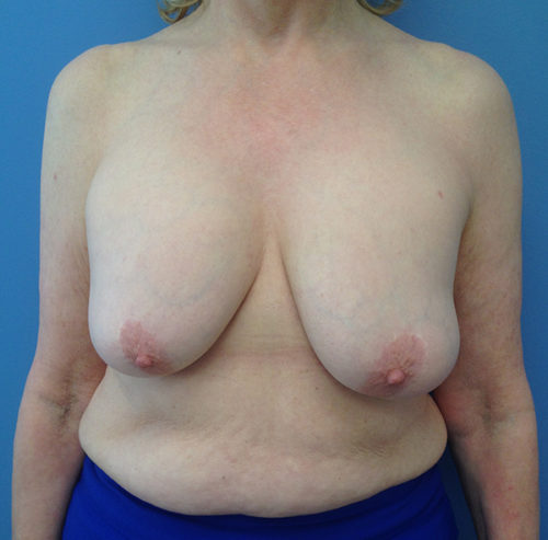 Breast Lift Case 1633 Before Photo Breast Lift