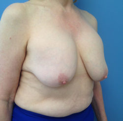 Breast Lift