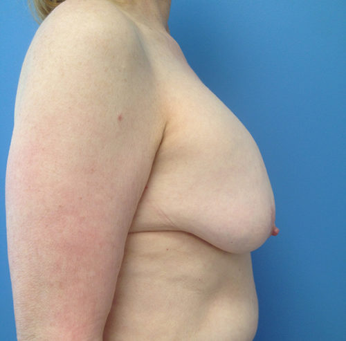 Breast Lift Case 1633 Before Photo Breast Lift