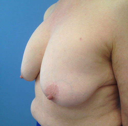 Breast Lift Case 1633 Before Photo Breast Lift