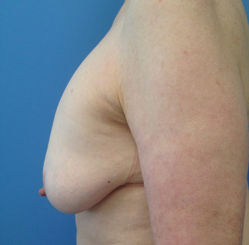Breast Lift Case 1633 Before Photo Breast Lift