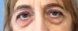 Eyelid Surgery