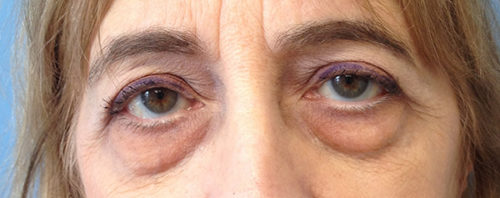 Eyelid Surgery Case 1634 Before Photo Eyelid Surgery
