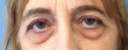 Eyelid Surgery