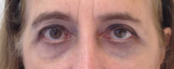 Eyelid Surgery