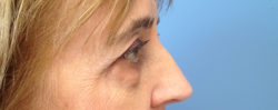 Eyelid Surgery