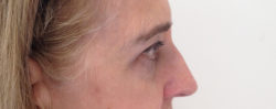 Eyelid Surgery