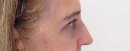 Eyelid Surgery Case 1634 After Photo Eyelid Surgery