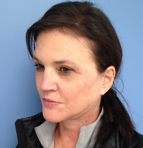 Face & Neck Lift Case 1629 After Photo Face & Neck Lift