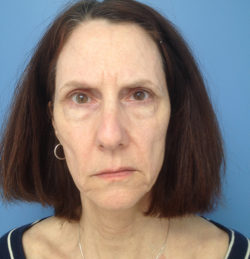 Face & Neck Lift